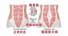 产后恢复难题：腹直肌分离如何有效应对？